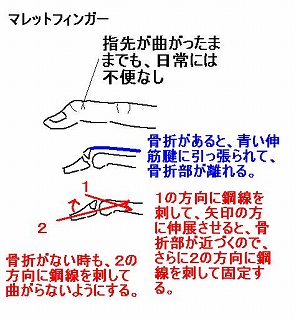 突き指 伸筋腱付着部の剥離骨折 指が曲がらない たなごころ治療院 葛飾区金町 マッサージ 鍼灸 全国各地から他では治らない 方がたくさん来院されています